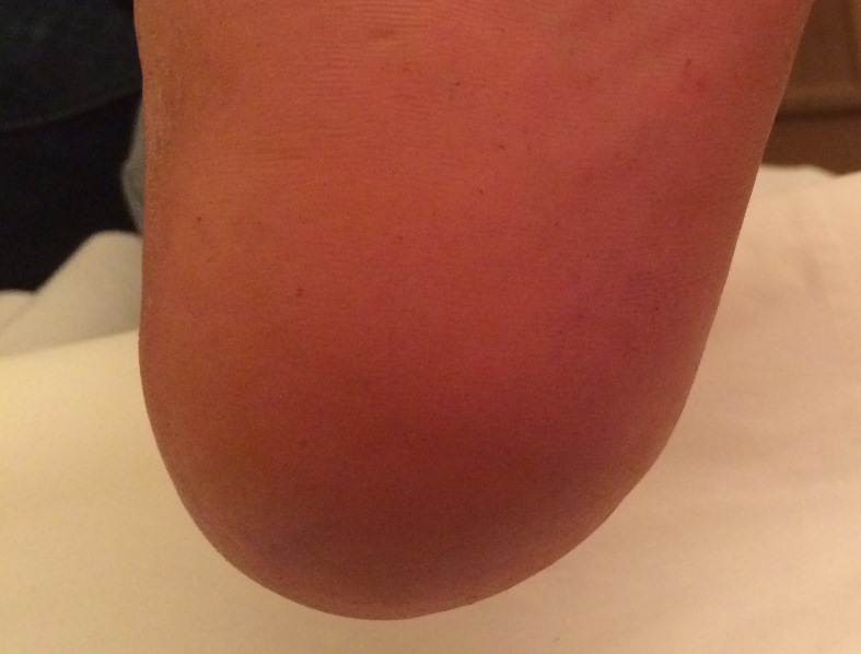 Before and After Foot Treatment Kent Foot & Ankle Clinic